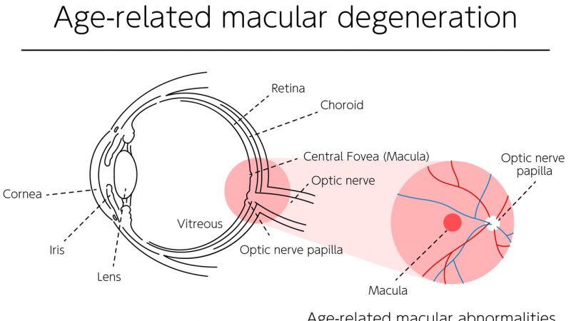 Macular Degeneration