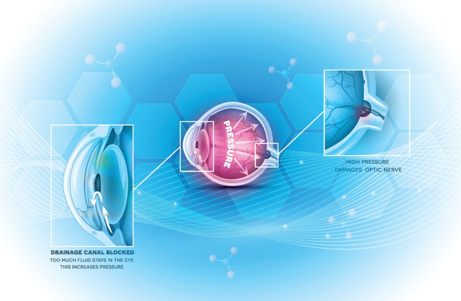 Glaucoma eye disease