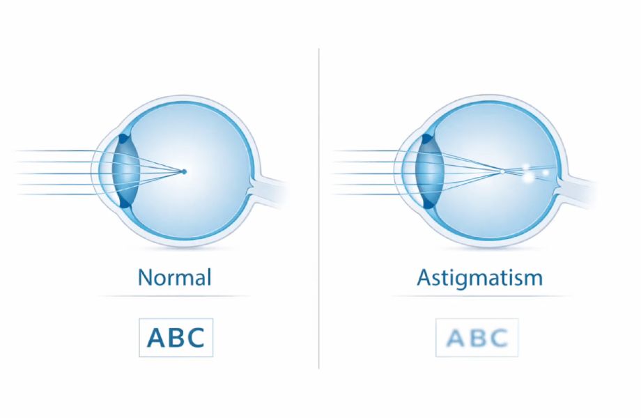 astigmatism diagram
