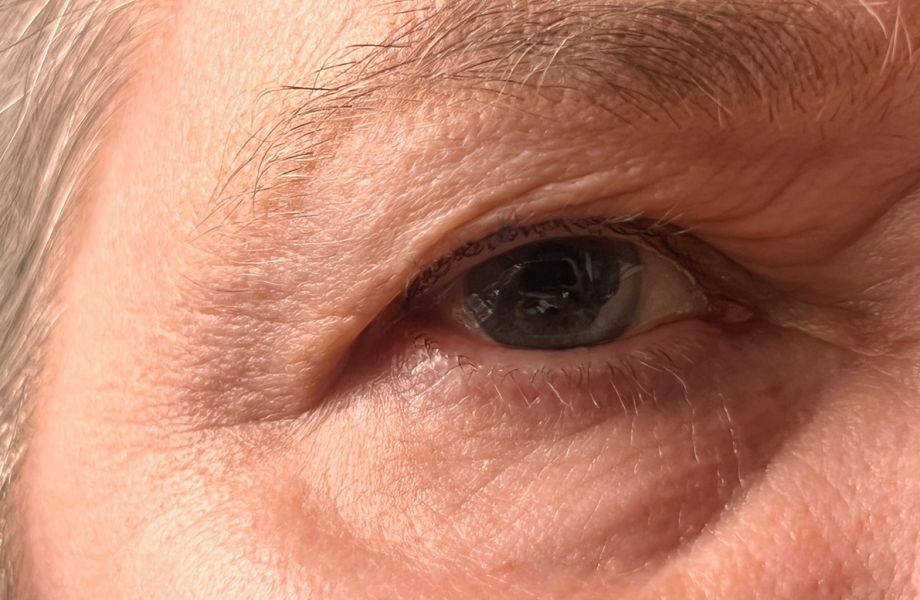 Blepharoplasty (Eyelid Surgery)