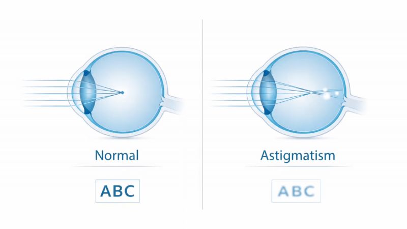 astigmatism diagram