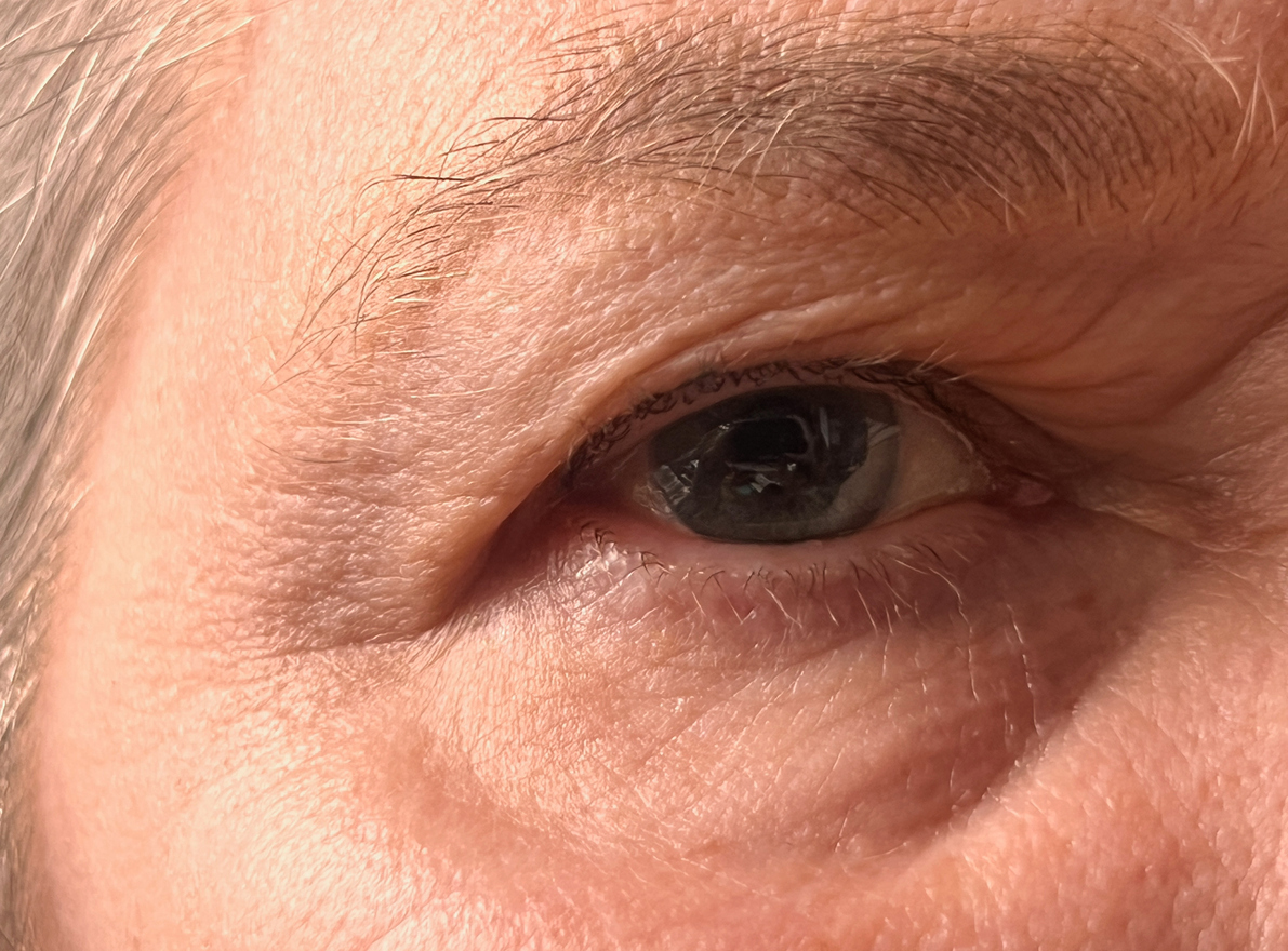 Blepharoplasty (Eyelid Surgery)