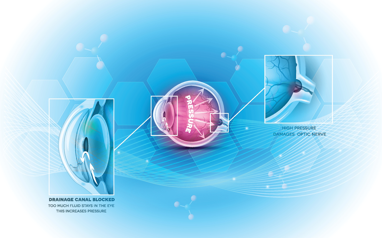 Glaucoma eye disease