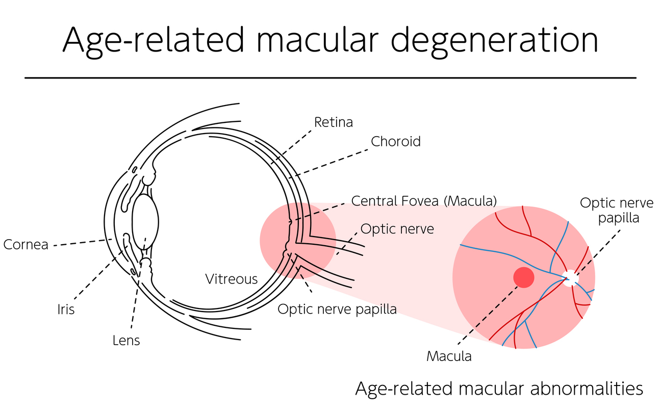 Macular Degeneration