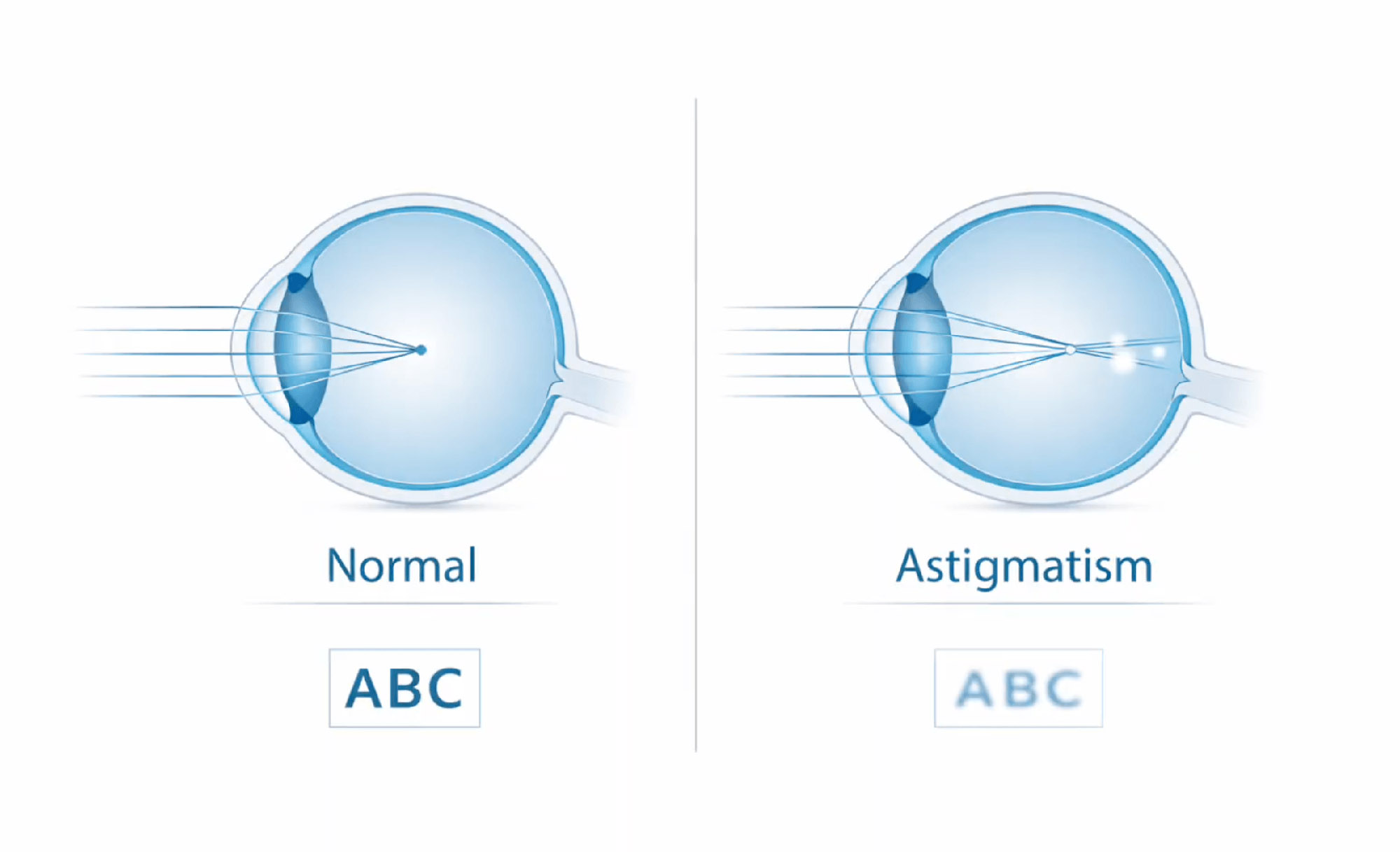 astigmatism diagram