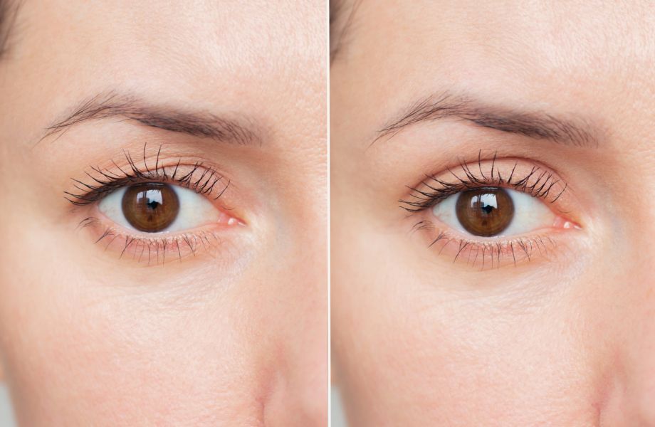 Eyelid Surgery