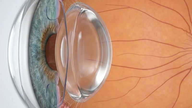 3D image of a lens procedure Phakic ICL diagram