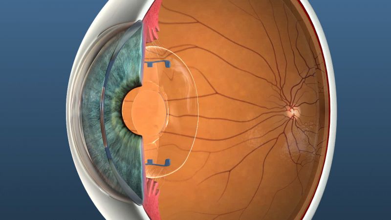 3D image of an eye for education on eye surgery