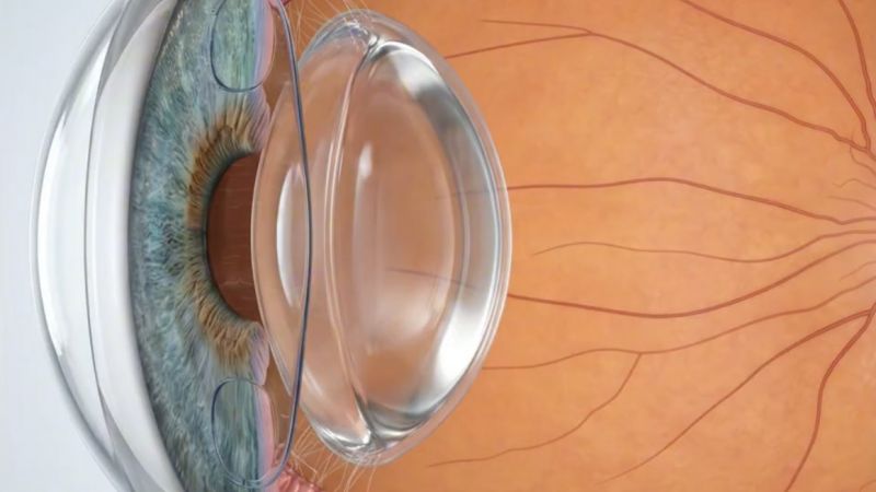 3D image of a lens procedure Phakic ICL diagram