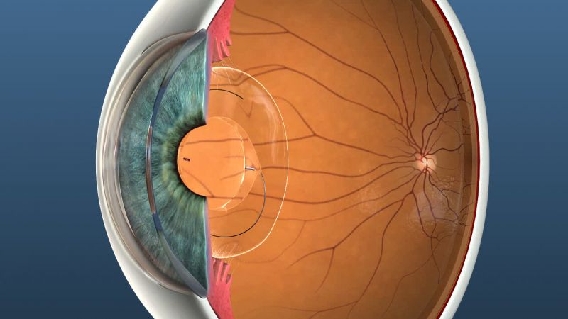 3D image of an eye for education on eye surgery