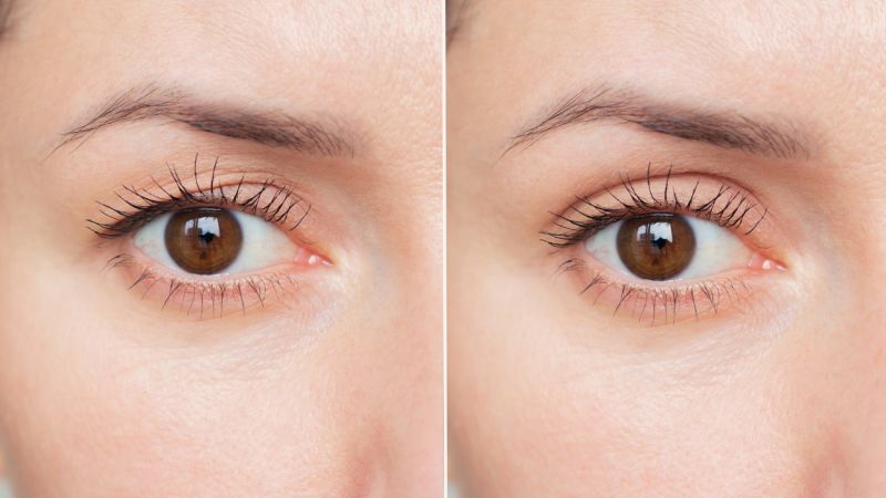 Eyelid Surgery