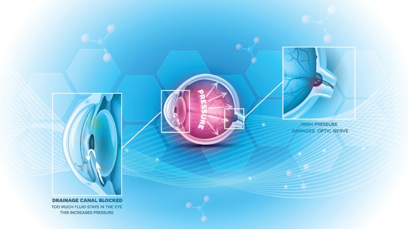 Glaucoma eye disease