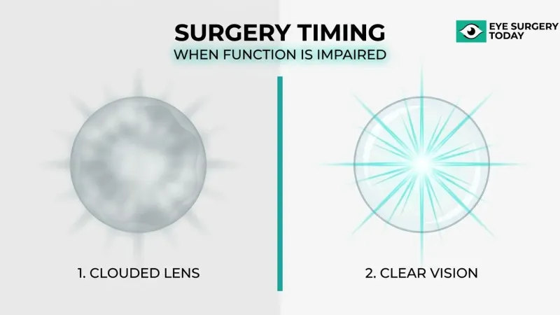 Cataract surgery timing illustration comparing a clouded lens with clear vision when daily function becomes impaired.