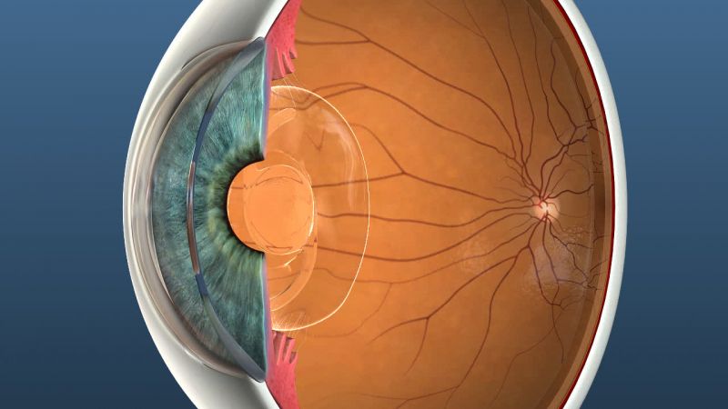 3D image of an eye for education on eye surgery