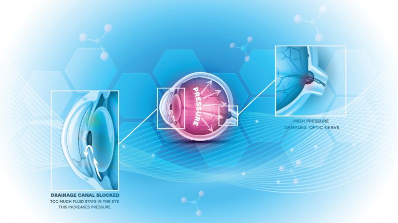 Glaucoma eye disease