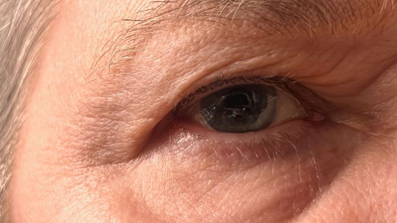 Blepharoplasty (Eyelid Surgery)