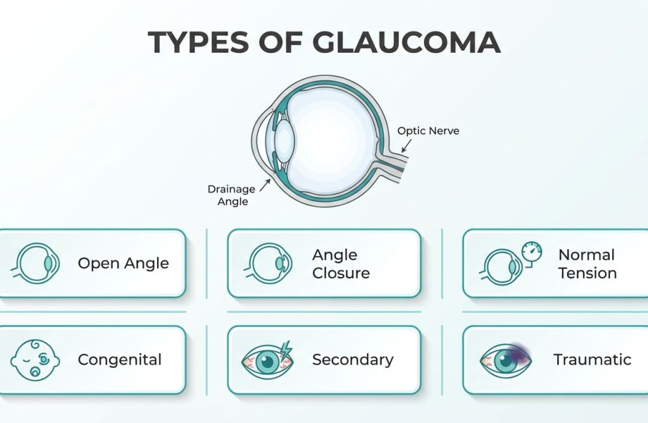 Types of Glaucoma: