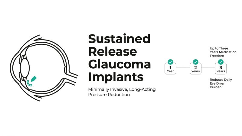 iDose and Sustained Release Implants for Glaucoma