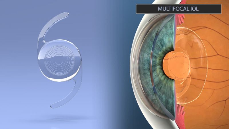 an image of a Multifocal lens